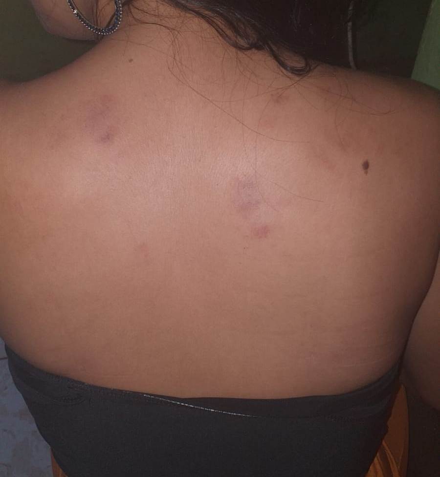 A mo&ccedil;a relatou a reportagem que al&eacute;m de ter sido violentada sexualmente, foi agredida com socos e tapas - Foto: Arquivo da v&iacute;tima / Divulga&ccedil;&atilde;o Ag&ecirc;ncia Tocantins 